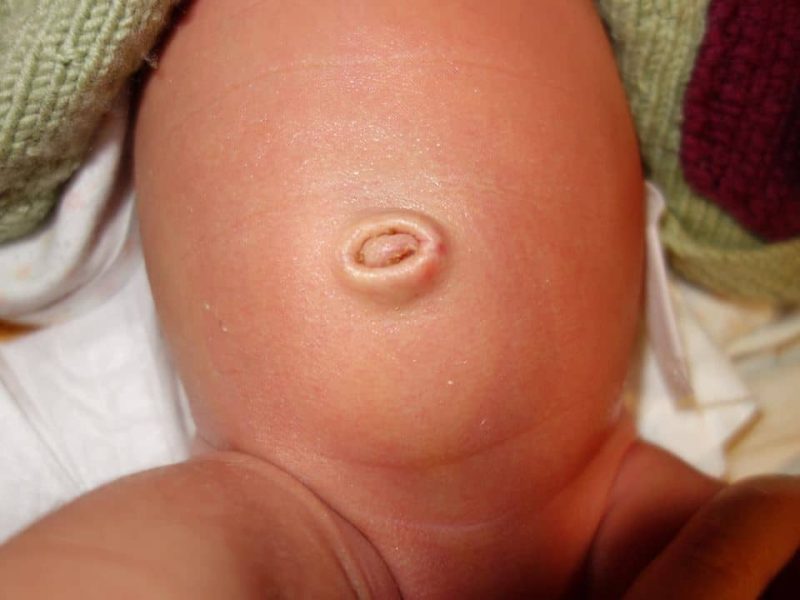 Belly button after natural detachment of umbilical cord, Lotus Birth on Placenta Remedies Network